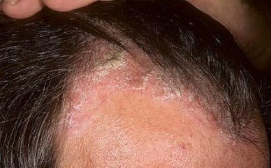 szampon dla mężczyzn na łojotokowe zapalenie skóry i łysienie androgeniczne