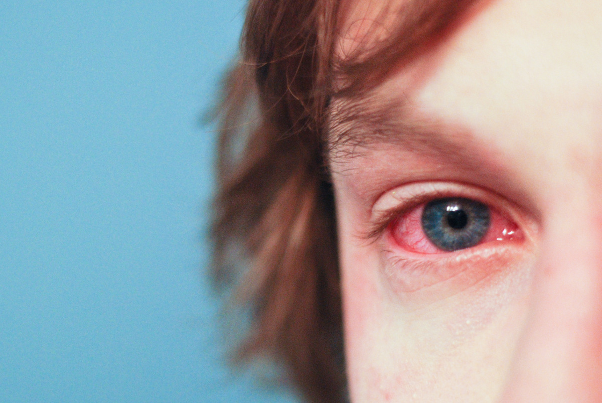alergia oczy na szampon objawy